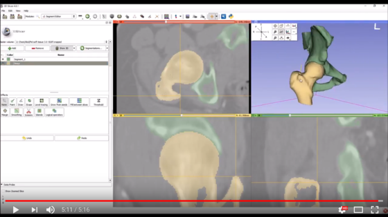 Video Tutorial: Femur and pelvis segmentation from CT