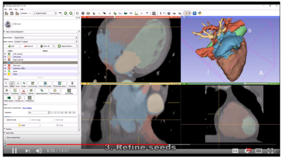 Video Tutorial: Whole heart segmentation from cardiac CT